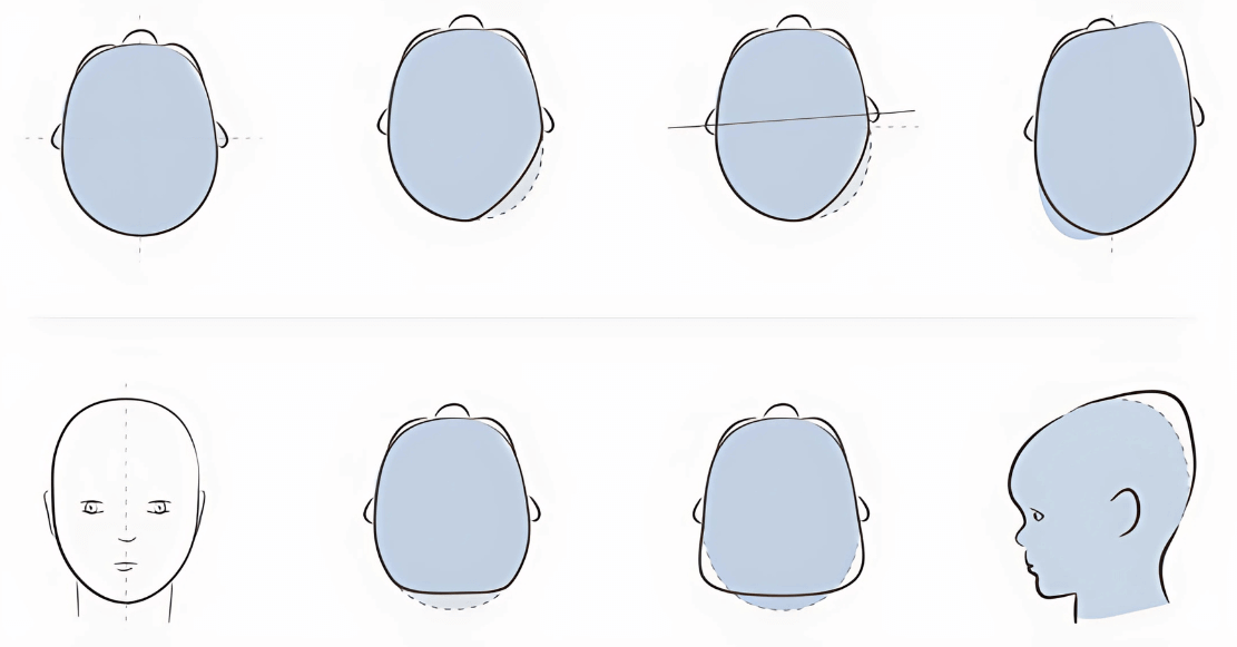 Positional Cranial Deformities (PCDs)